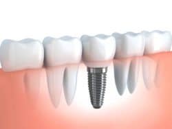 Get Your Smile Back with Dental Implants