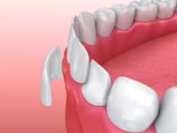 Transform Your Smile With Porcelain Veneers in Akron, PA