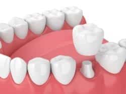 Dental Crowns Help Restore Your Smile in akron pa