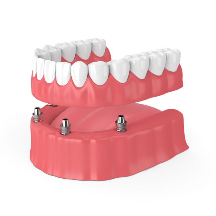 Restore Teeth in Akron, Pennsylvania