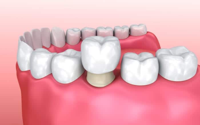 Dental Crowns in Akron, Pennsylvania