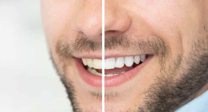 Treat Discolored Teeth in Akron, PA