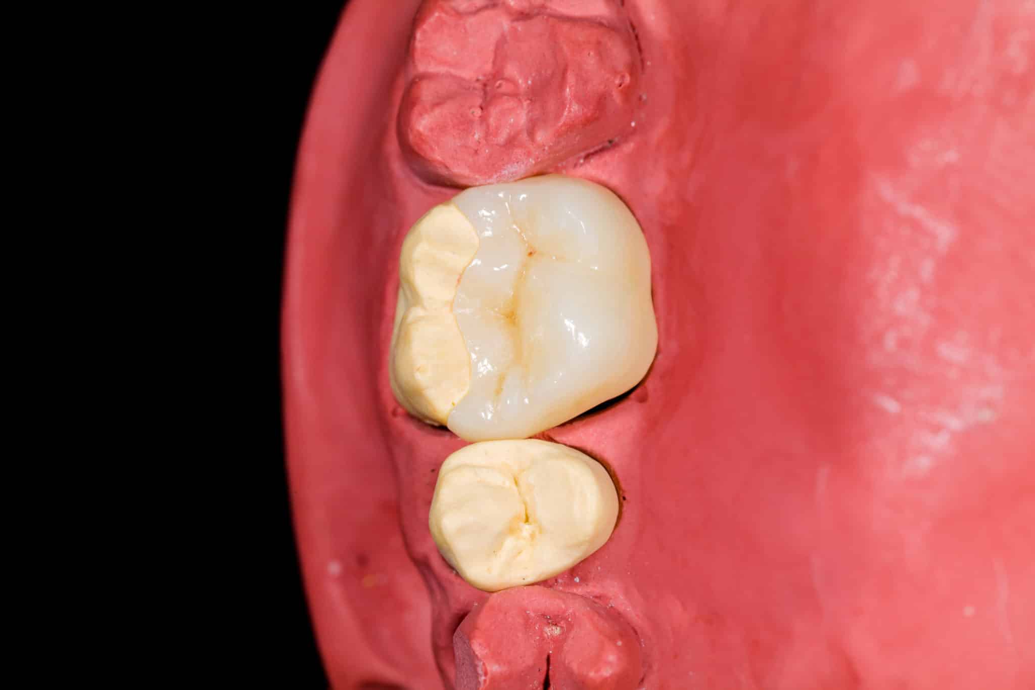 Dental Bonding and Porcelain Veneers in Akron, Pennsylvania