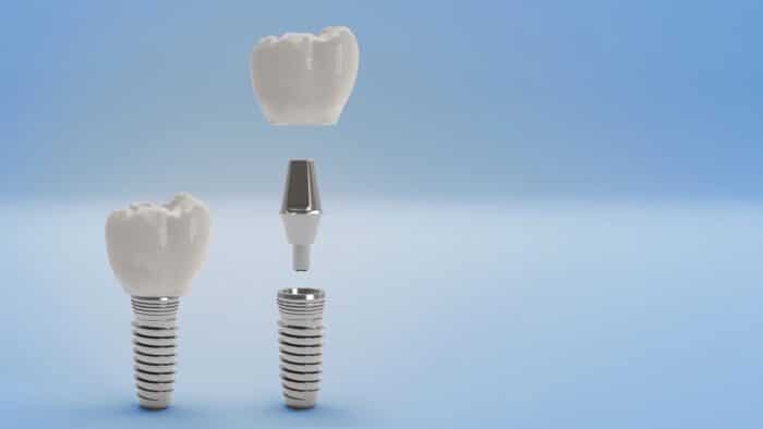 Answering Dental Implant FAQs