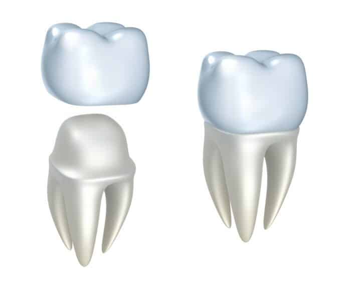 A DENTAL CROWN in LITITZ PA needs extra care and attention to last you a long time