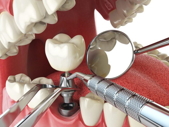 DENTAL IMPLANTS in LITITZ PA can be a lengthy process for smile restoration