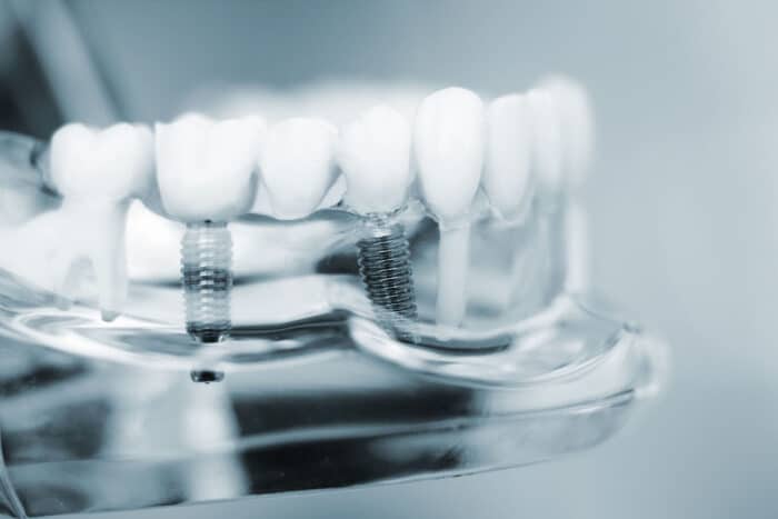 Dental bridges are common restoration options that could help improve your smile and bite after tooth loss.